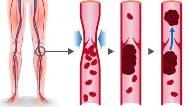 خطرات لخته خون در پا، علائم و راه‌های پیشگیری